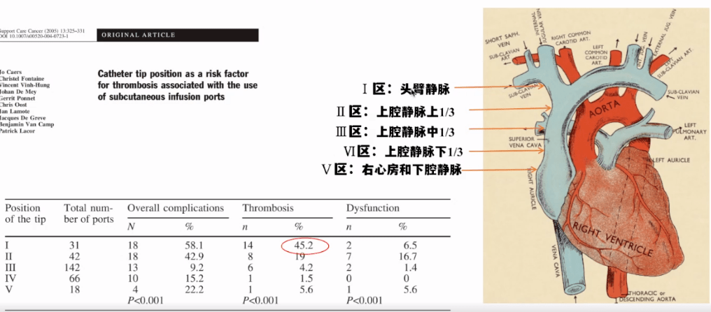 研究表明导管尖端定位是血栓形成的最重要危险因素;头臂静脉或上腔