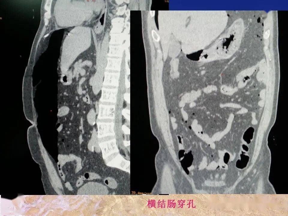 消化道穿孔ct影像大汇总看完印象深刻