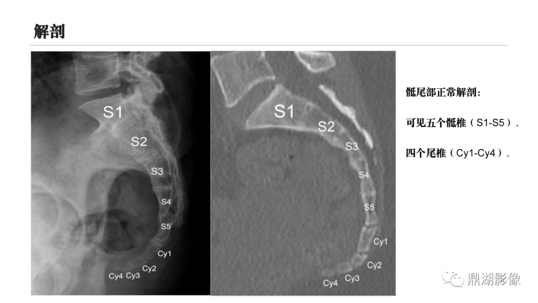 yyds这篇尾骨病变影像诊断的总结太赞了