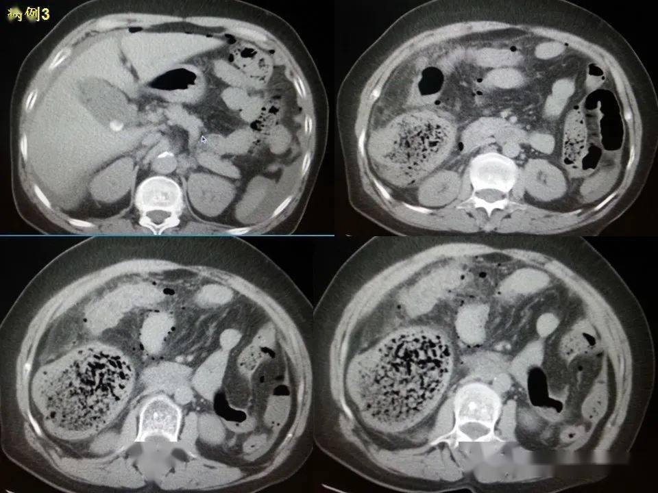 消化道穿孔ct影像大汇总看完印象深刻