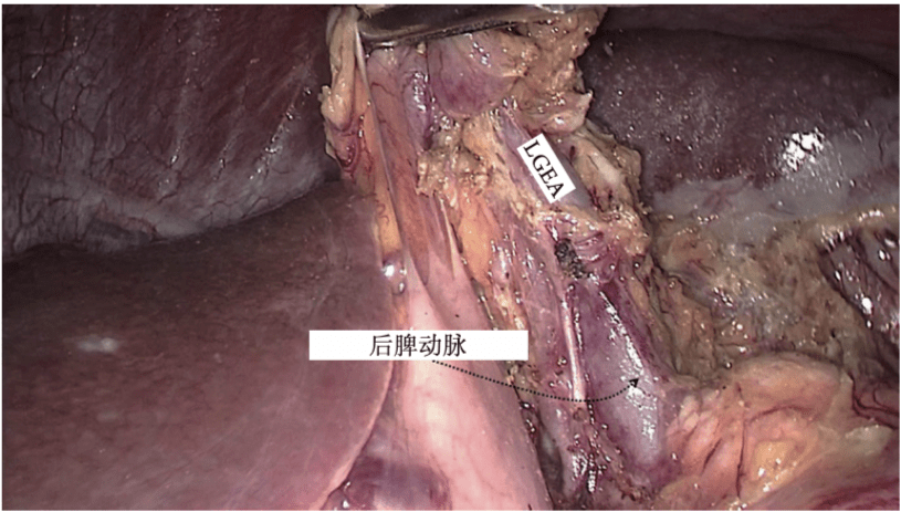 《腹腔镜胃肠手术笔记(第二版)》新书抢先看_网膜_淋巴结_结肠