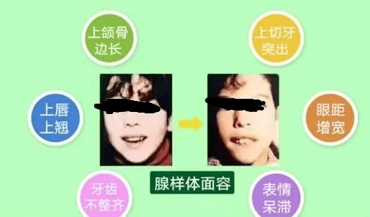 由于长期张口呼吸,影响面骨发育而致上颌骨狭长,硬腭高拱变窄,牙齿