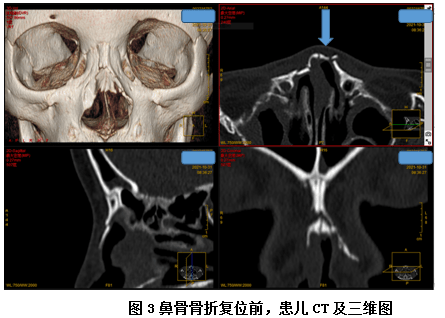 孙晓卫说,鼻骨侧位x线片相对来说比较经济,便捷,是诊断鼻骨骨折重要