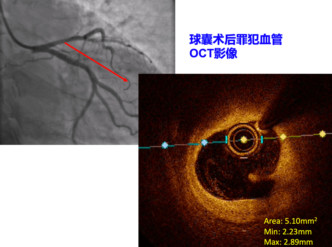 风险管理丨黄兵:pcsk9抑制剂促进acs患者ptca术后破裂斑块修复_mmol