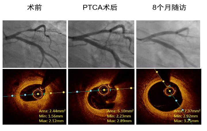 风险管理丨黄兵:pcsk9抑制剂促进acs患者ptca术后破裂斑块修复_mmol