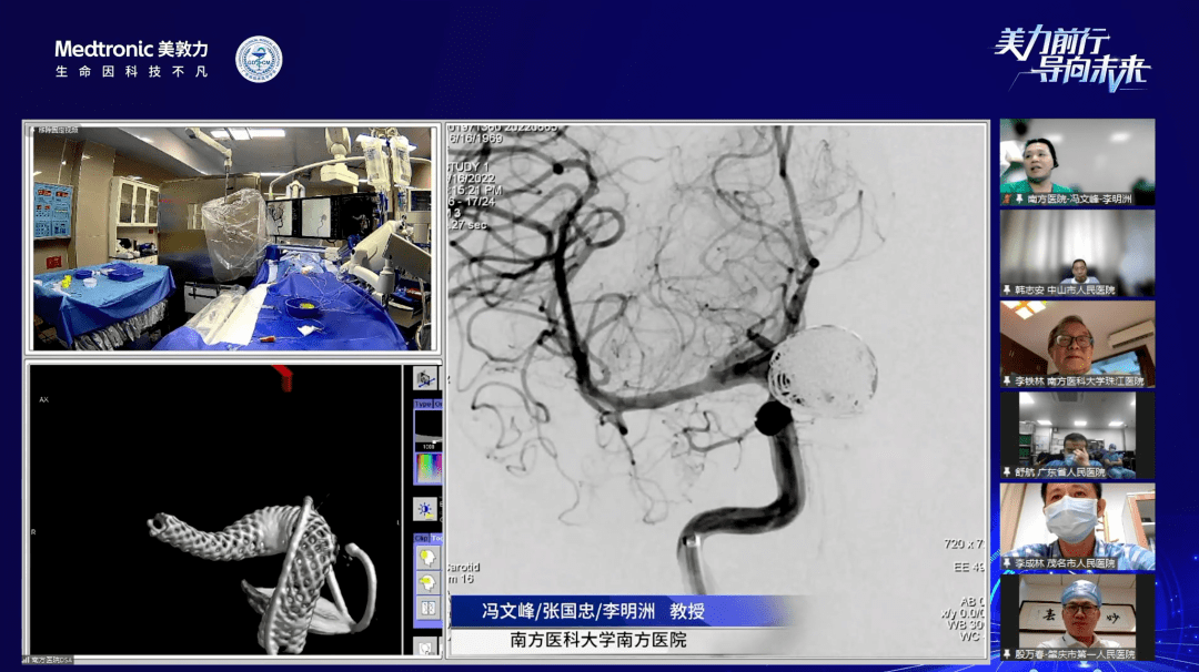 手术过程行动脉造影并行3d重建后可见右侧颈内动脉海绵窦段大动脉瘤