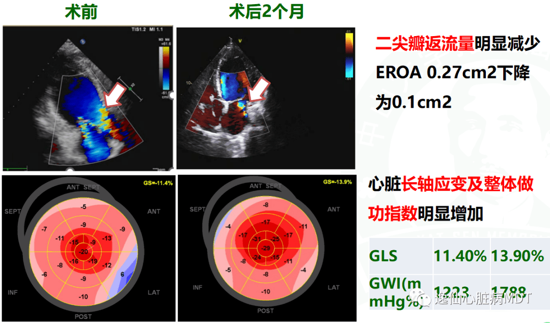 反复心衰住院 15 次,nt-probnp 4091 pg/ml,如何救治?_mmhg_治疗_qd