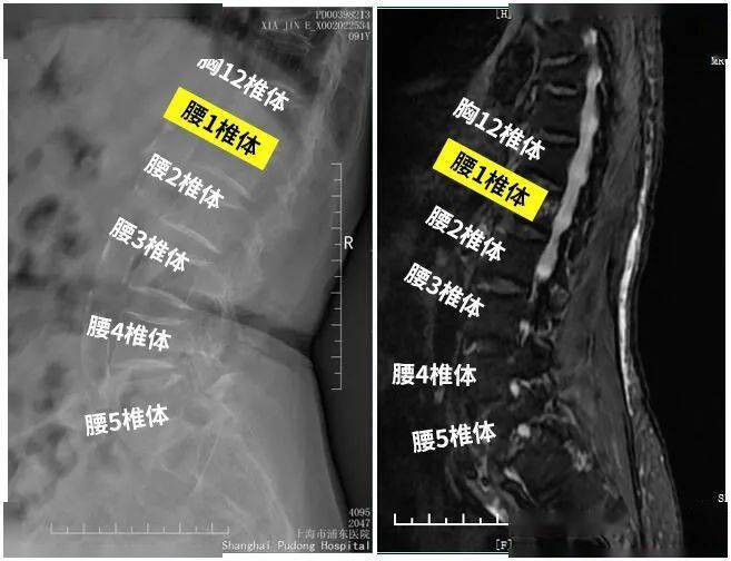 术前x线,ct,mri提示:l1椎体压缩性骨折2病例二女性,67岁,摔伤导致腰背