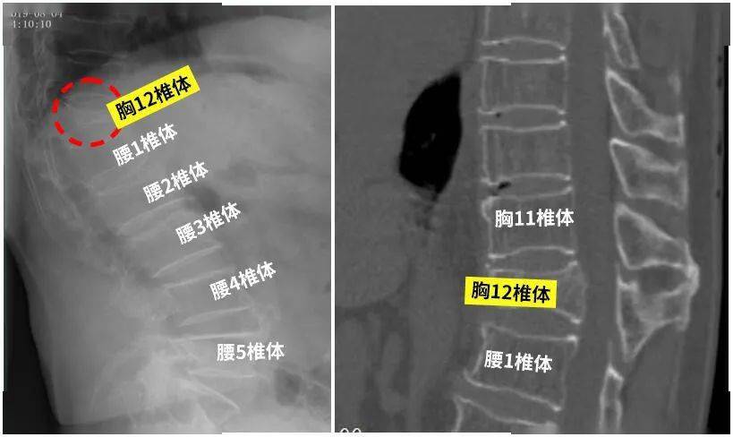 术前x线及ct提示:t12椎体粉碎性骨折骨质疏松性骨折根源在骨质疏松