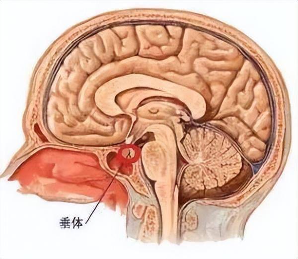 那可不一定—泌乳素型垂体瘤_肿瘤_患者_激素