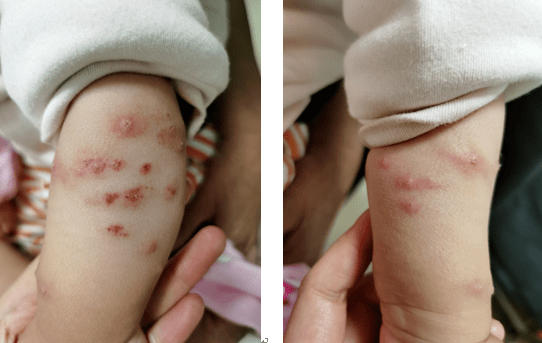 丘疹性荨麻疹是由吸血节肢动物叮咬所致的一种过敏反应,又名急性单纯