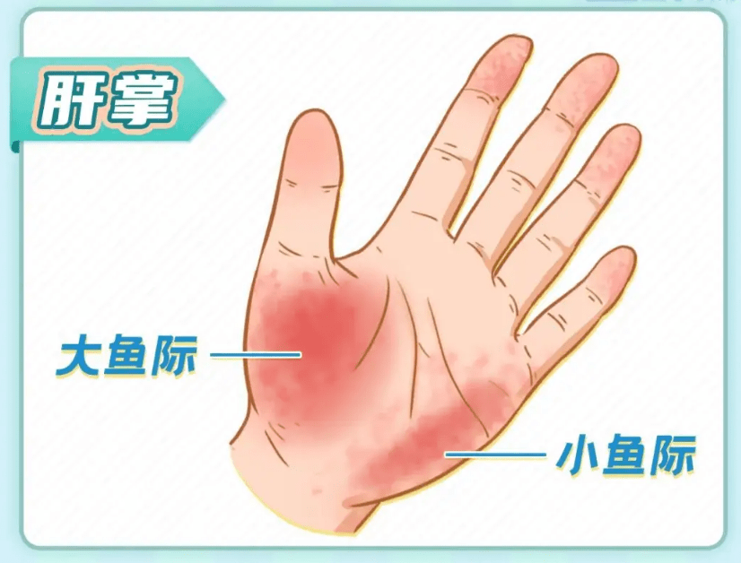 肝掌主要表现为手掌的大,小鱼际发红.