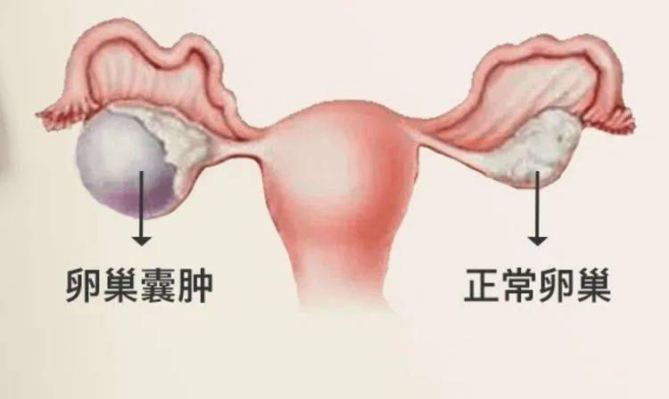 通过超声检查再三确认后但是这么巨大的囊肿甚是罕见妇科盆腔囊肿很