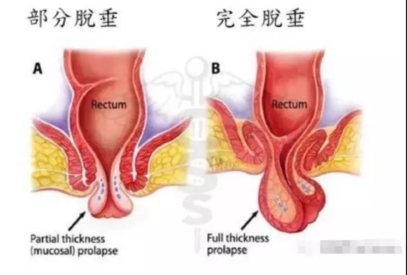 直肠脱垂的治疗依年龄,严重程度的不同而不同,主要是消除直肠脱垂的