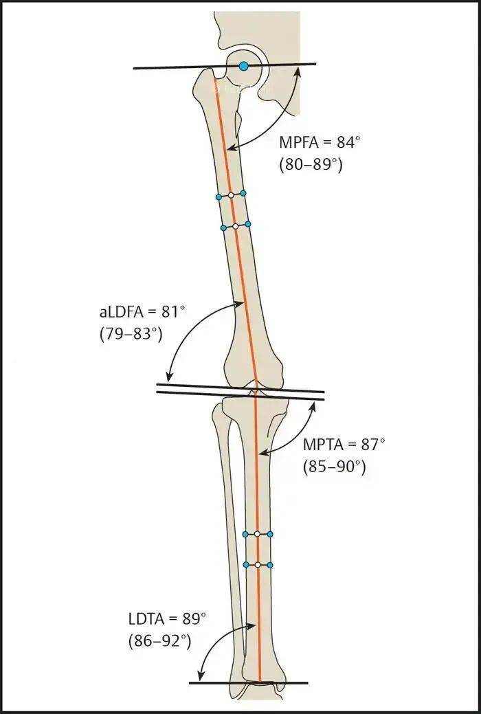 胫骨远端外侧角(aldta,正常:89(86~92.