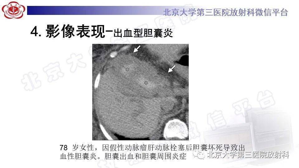 胆囊炎影像诊断