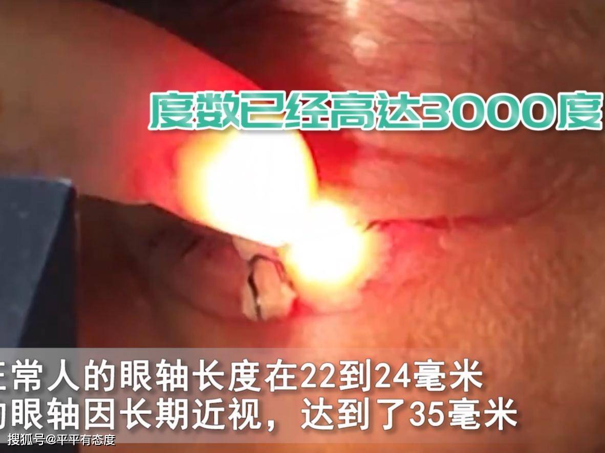 女子高度近视3000度，被迫摘除眼球，先天原因？