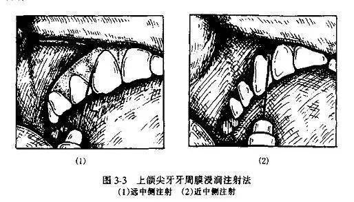 末梢神经_局部_注射法