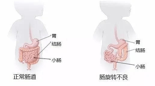 【“星”技术】惊！肠打结？看普外科如何“扭转乾坤”！