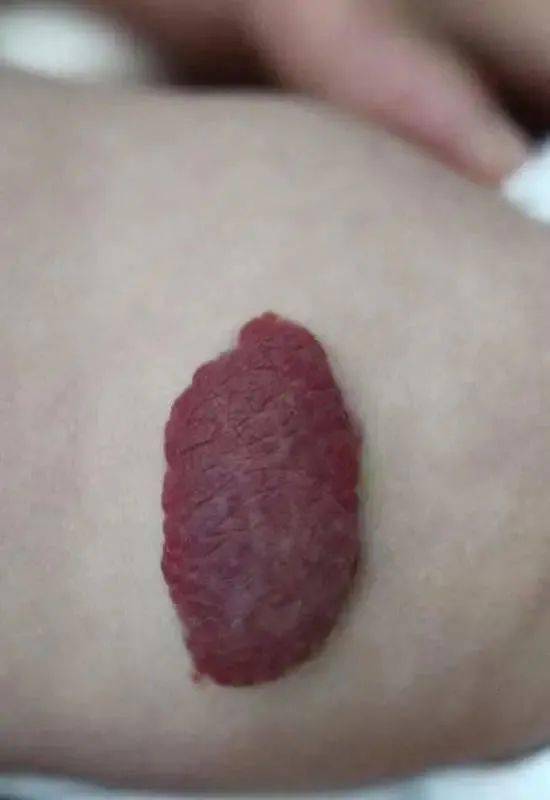 什么是婴幼儿血管瘤？婴幼儿血管瘤是来源于血管内皮细胞的先天性良性肿
