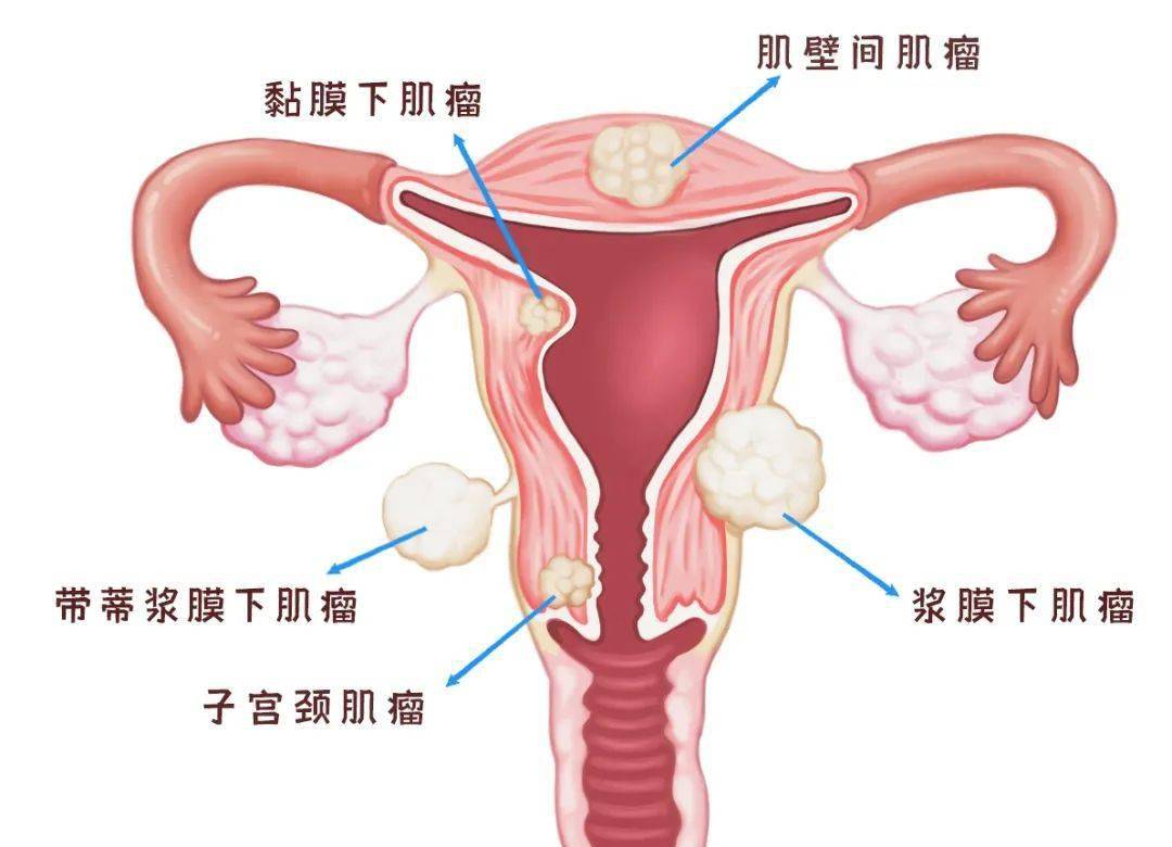 02、子宫肌瘤子宫肌瘤是一种常见的良性肿瘤它在子宫壁内生长，大小和数