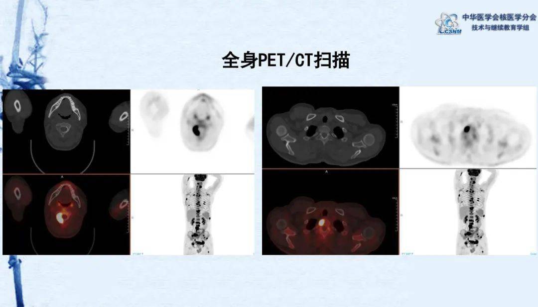 【继教】宋天彬、张春：《副神经节瘤（pgl）pet/ct显像一例》