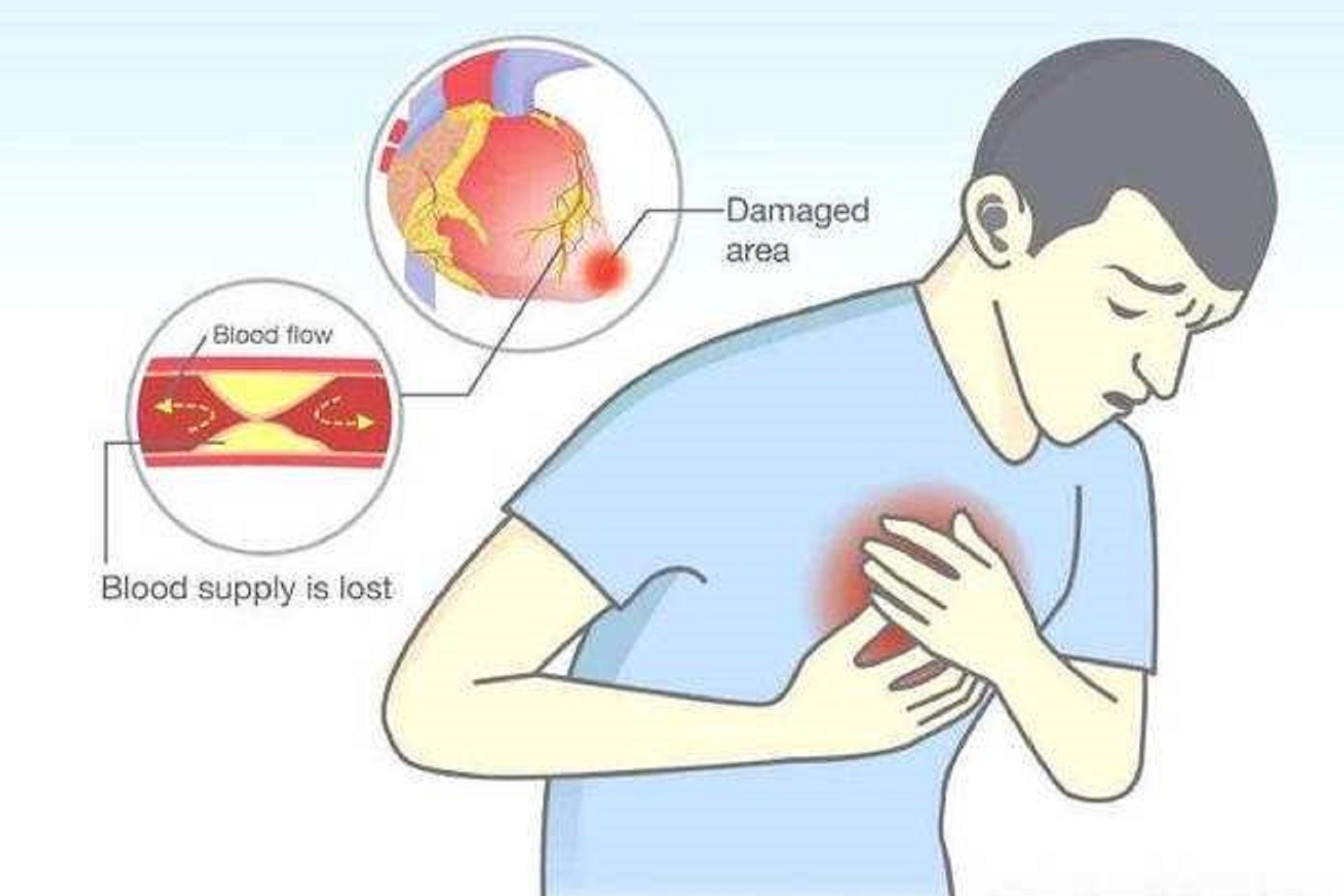 冠心病血管堵塞缺血老中医分享名方