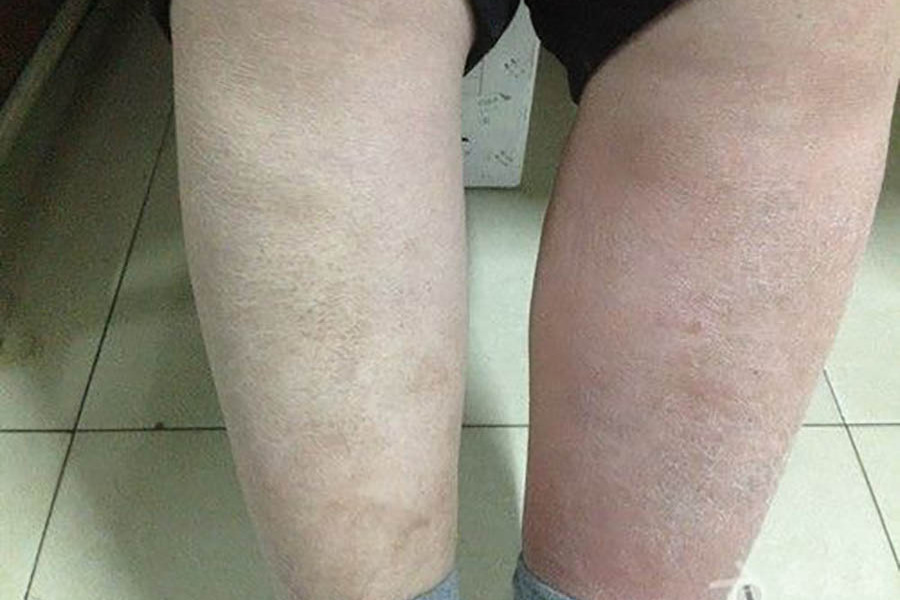 为何会腿肿涨原因最常见下肢静脉曲张引起