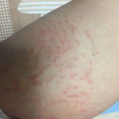 秋季皮肤瘙痒、起红疹，这是怎么回事？-搜狐大视野-搜狐新闻