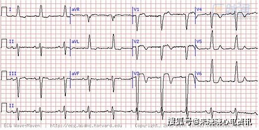 心肌梗死不可錯過的心電圖線索