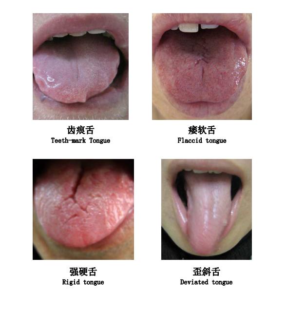 舌诊:人体脏腑气血及其功能状况的晴雨表