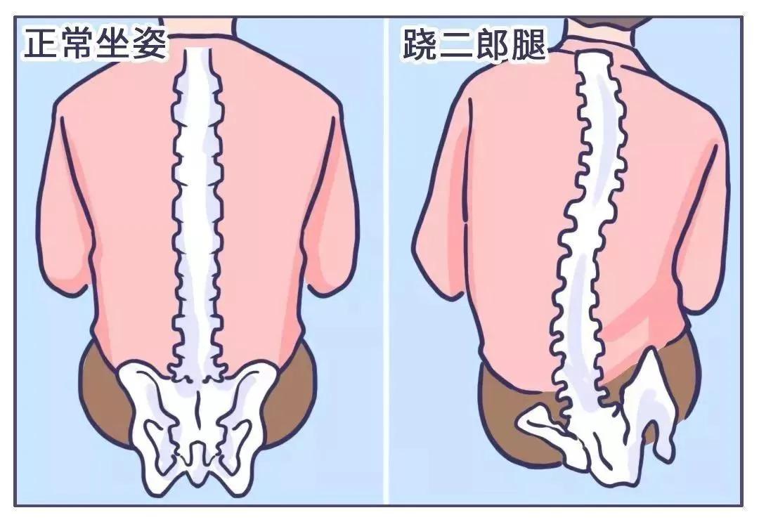04跷二郎腿会导致脊椎变形,引起下背疼!