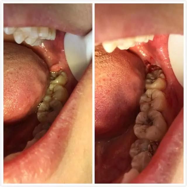 阻生智齿龈瓣覆盖,影响咀嚼,水激光切除,术后立即止血.