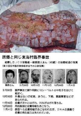 日本核辐射83天死亡图片