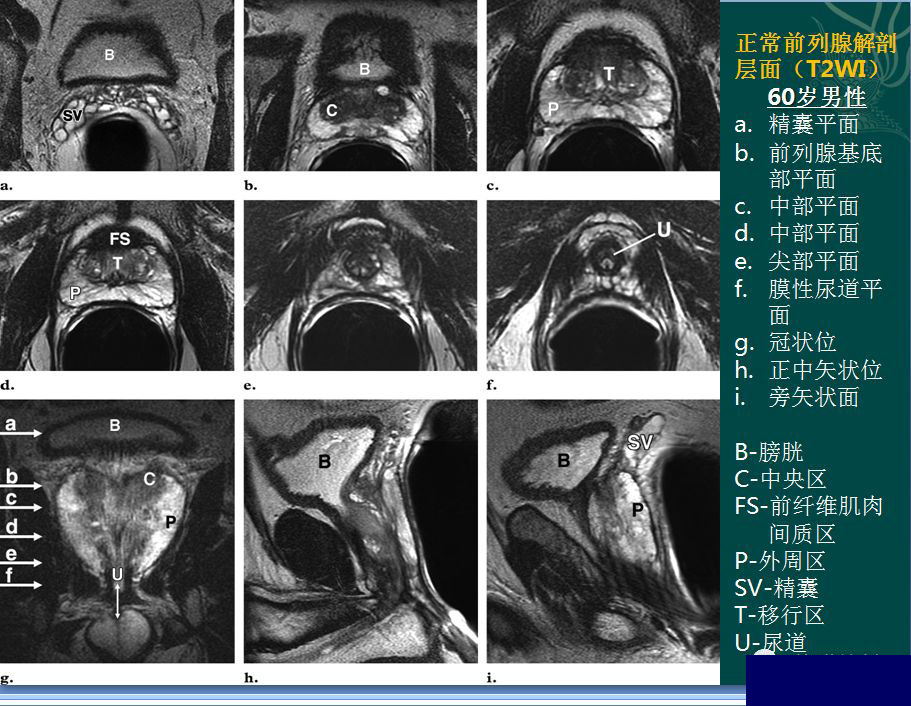 精彩解剖 腎臟,輸尿管,膀胱,腎上腺,前列腺