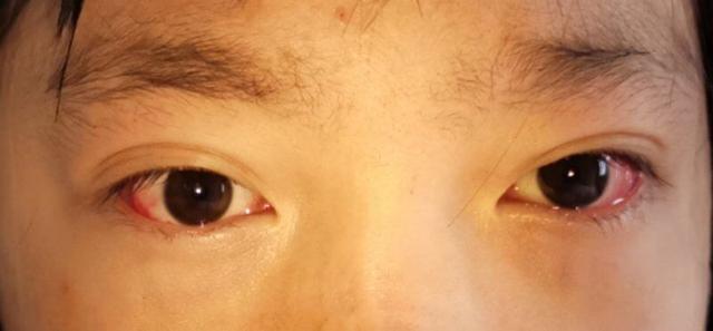 斜视手术不可怕,可怕的是没有正视斜视的危害