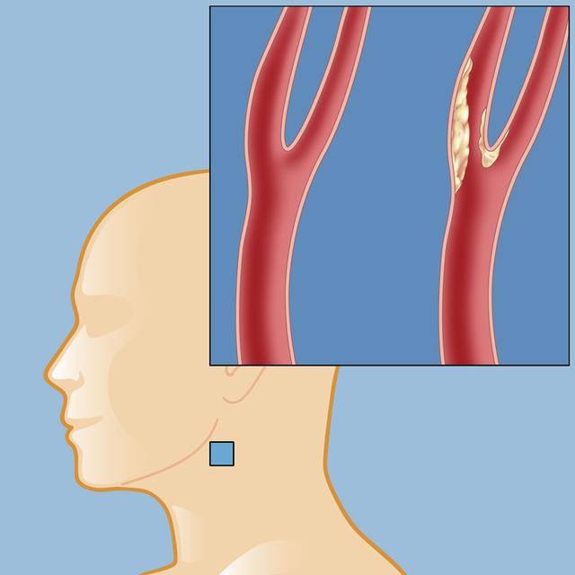 双侧颈动脉斑块图片图片