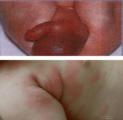 女性阴囊皮脂腺图片图片