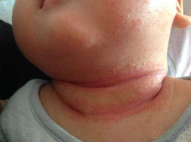 捏积派夏天宝宝淹脖子是怎么回事如何预防护理