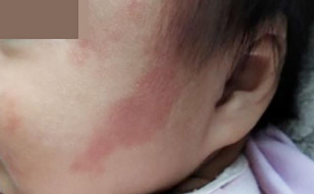 有些胎记是良性的,如淡红色的草莓胎记,如果面积不大基本会随着时间