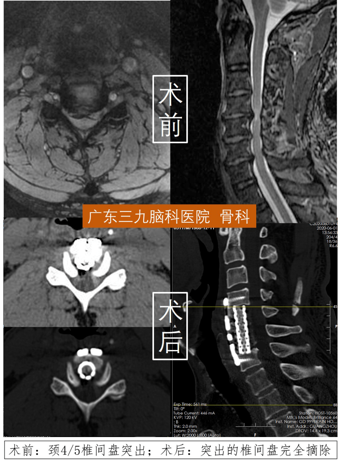 低頭族注意了!醫生提醒:嚴重的頸椎病,確診後建議儘快手術