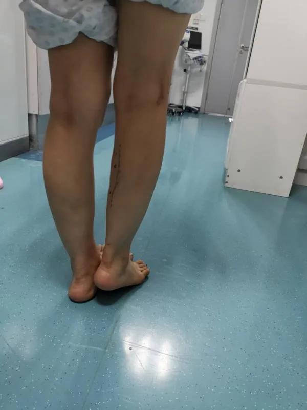 女子花费万元打瘦腿针,数月后右小腿短了一截