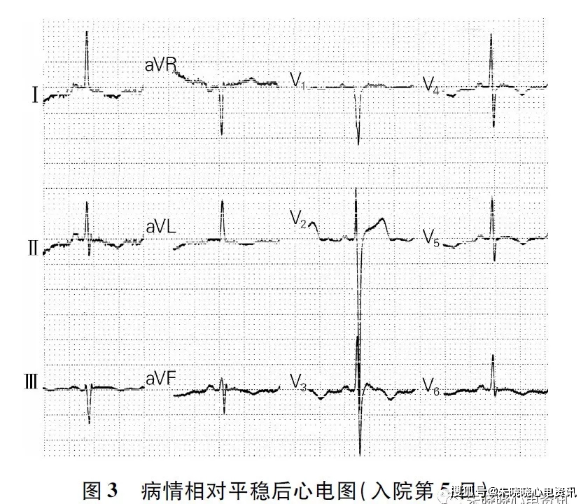 脑出血后尼亚加拉瀑布样t波并脑心综合征一例_心电图