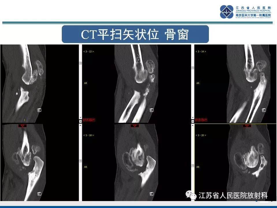 肘夏科氏关节病