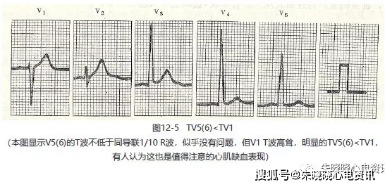 6.u波倒置