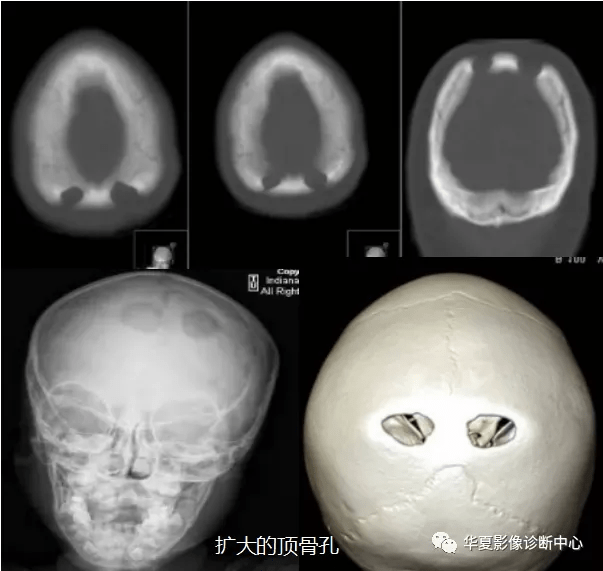 影像基礎顱骨這些變異不要誤認為是病變