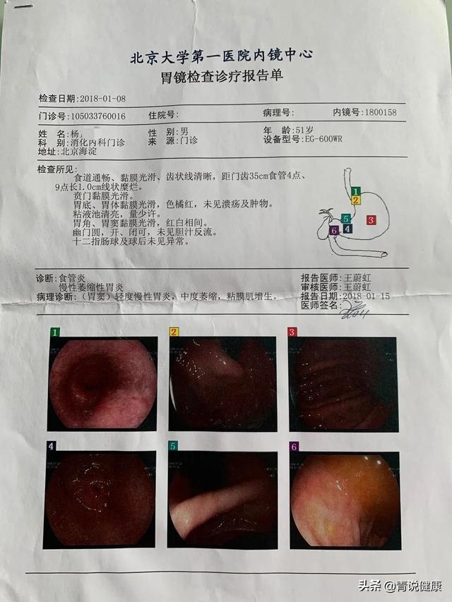 我将杨先生的胃镜检查前后对比报告放在文章里,为大家提供一个参考