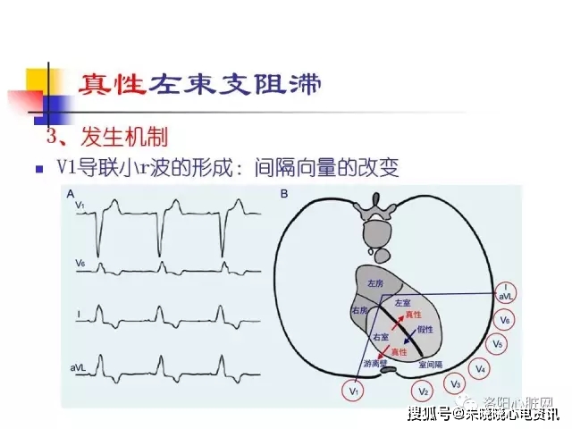 郭继鸿教授左束支阻滞性心肌病