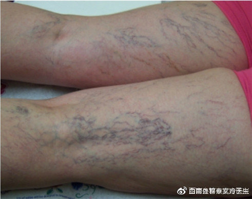 下肢静脉曲张早期症状有哪些?_皮肤