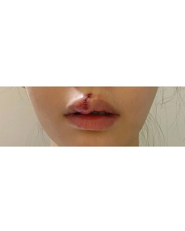 女星去流浪狗收容所献爱心被狗咬烂嘴唇,打破伤风针,伤情照曝光